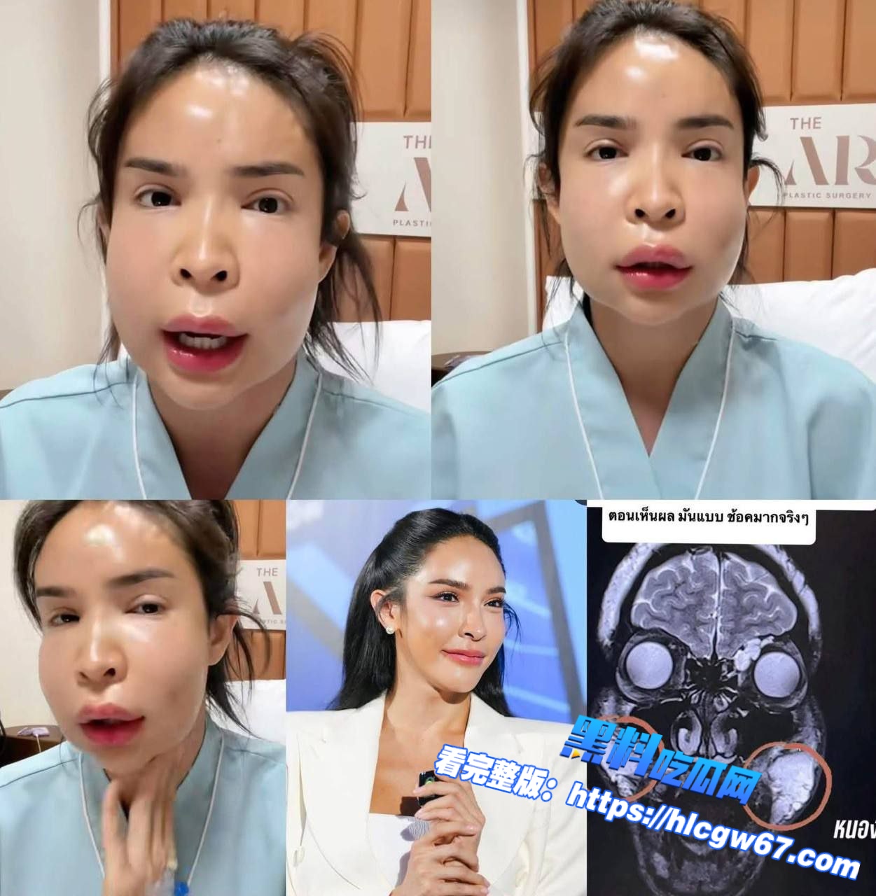 泰国网红贪便宜去无证医美失败01