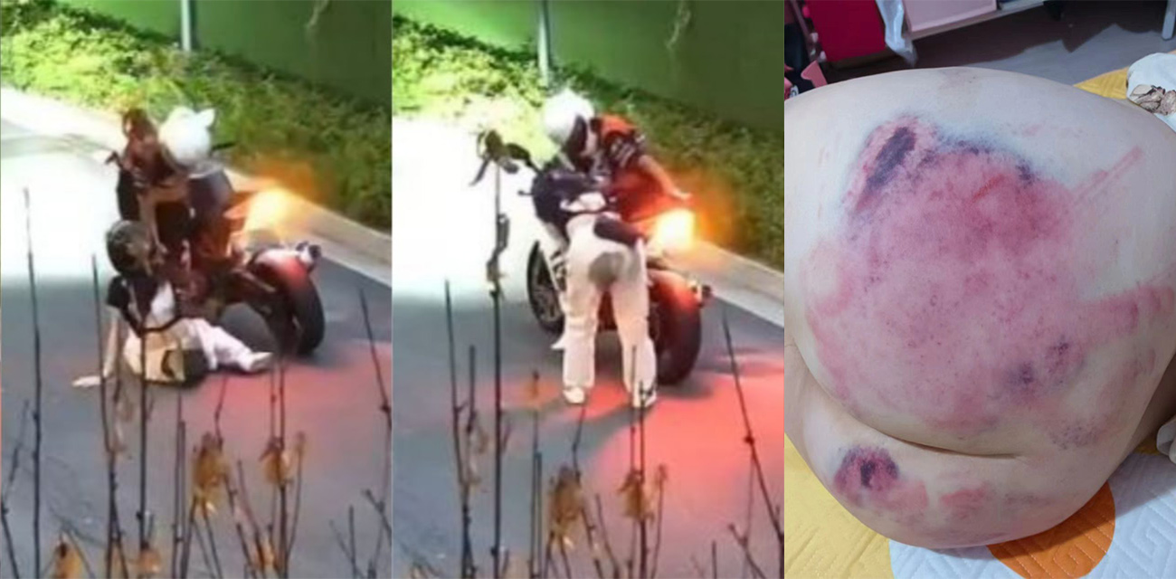 爆笑奇葩事件!女子乘坐摩托车后座掉到车轮上 屁股被严重烫伤!