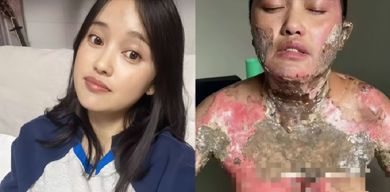 四川凉山一女子称被丈夫家暴后泼白酒点火,导致大面积烧伤,画面可能引起不适,慎入!
