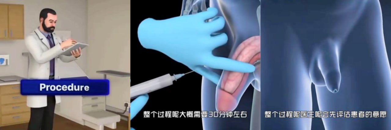 非手术性阴茎增大科普展示视频!不求牟利只求能为瓜友谋福利~
